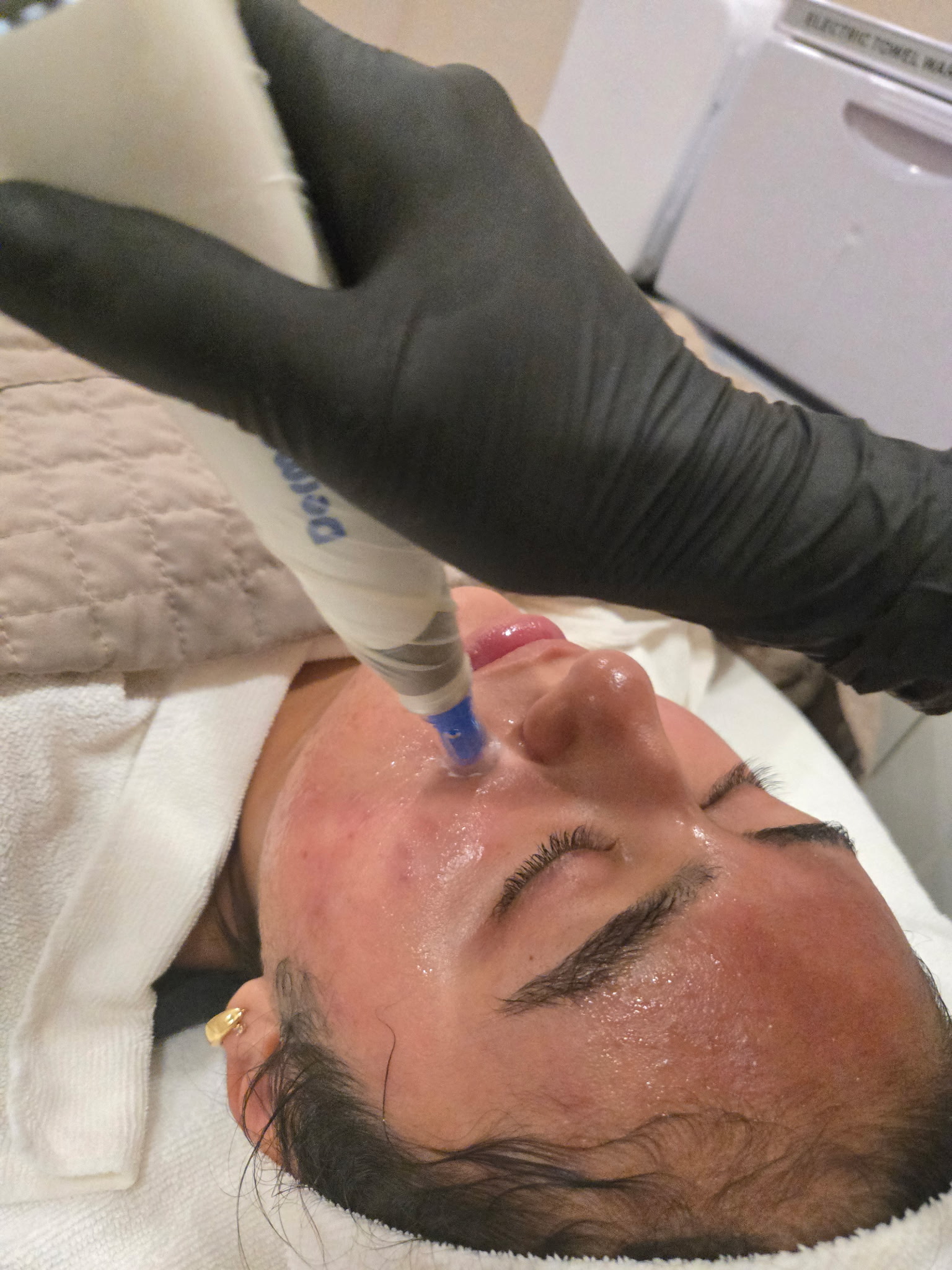microneedling