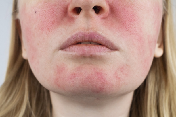 Rosacea
