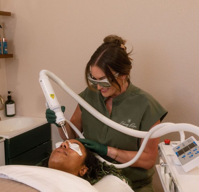 Aerolase Neo Elite acne treatment session at Honey Rose Aesthetics near Tacoma
