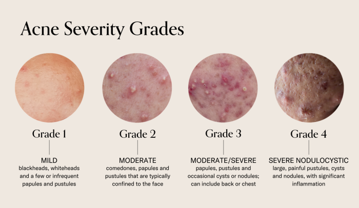 Chart showing the four grades of acne severity used in professional acne treatment