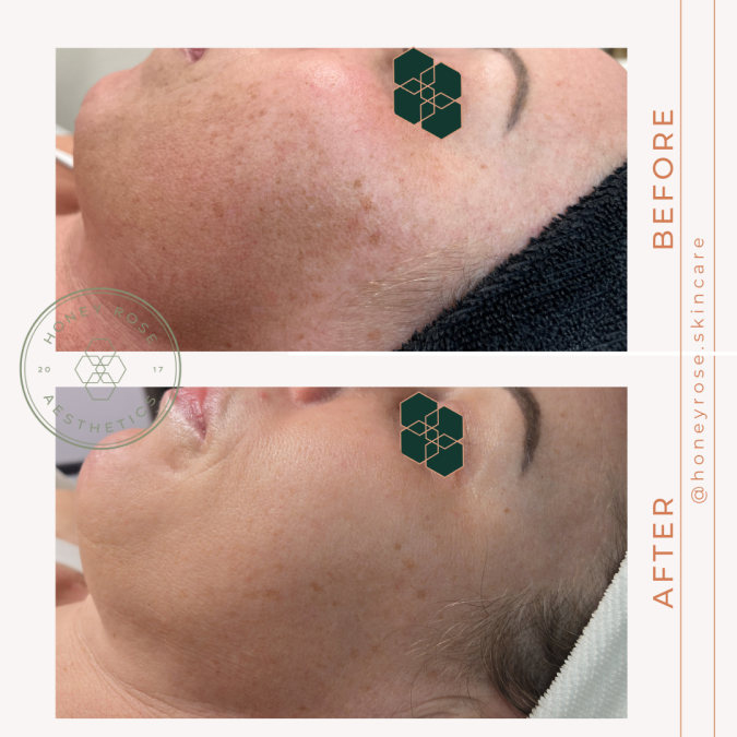Client skin after a chemical peel series at Honey Rose Aesthetics in Puyallup
