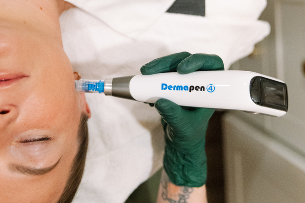 Microneedling session designed to support collagen production